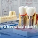 How Do Screwless Dental Implants Work