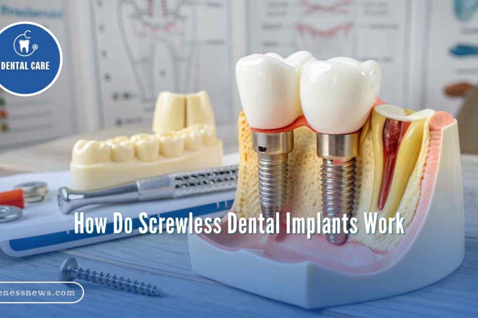 How Do Screwless Dental Implants Work