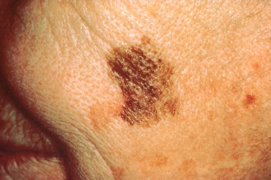 The Latest Trends in Dermatology for Skin Cancer Detection