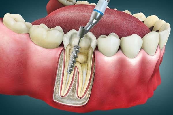 What Happens During a Root Canal Procedure and Aftercare