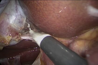 Common Questions About Gallbladder Surgery