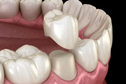 How Crowns Can Prevent Tooth Loss and Strengthen Teeth