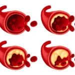 How Interventional Radiology Is Used for Vascular Conditions