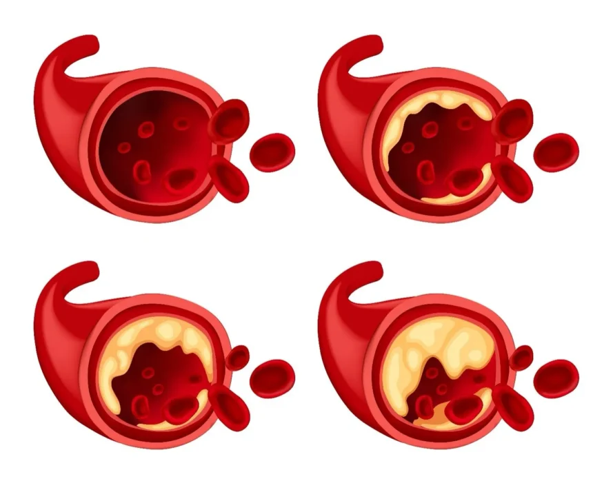 How Interventional Radiology Is Used for Vascular Conditions