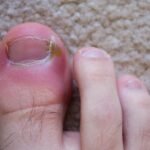 How to Tell if you Have an Ingrown Toenail?