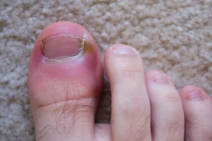 How to Tell if you Have an Ingrown Toenail?