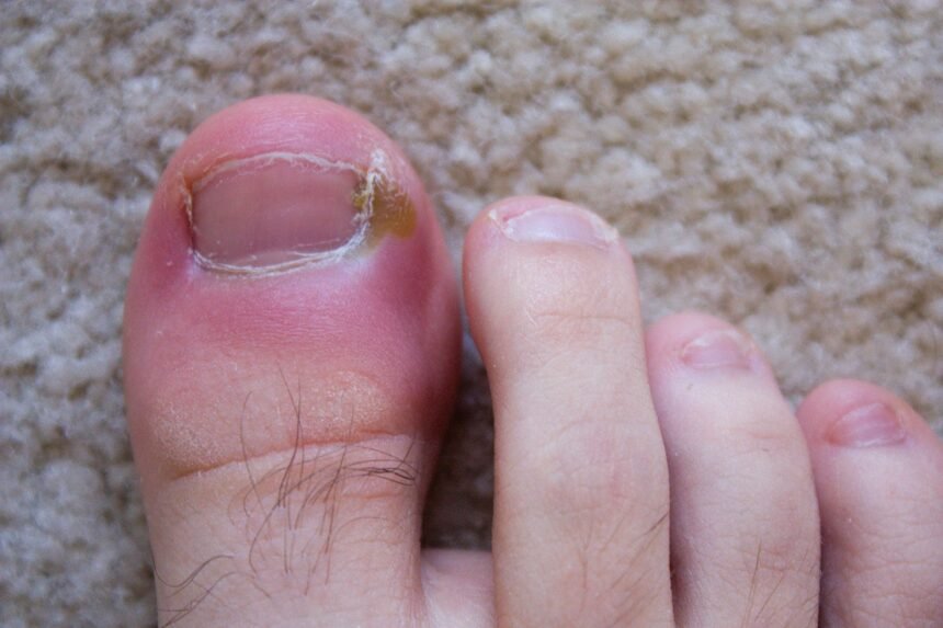 How to Tell if you Have an Ingrown Toenail?