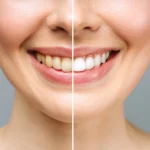 Seeking Cosmetic Procedures To Boost Dental Aesthetics