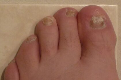 Symptoms and Treatment Options of Fungal Nails