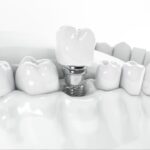 The Essential Role of an Implant Specialist in Complex Restorative Dentistry