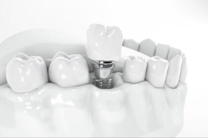 The Essential Role of an Implant Specialist in Complex Restorative Dentistry