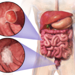 The Importance of Early Detection in Colon Cancer Survival Rates