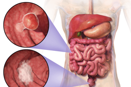 The Importance of Early Detection in Colon Cancer Survival Rates