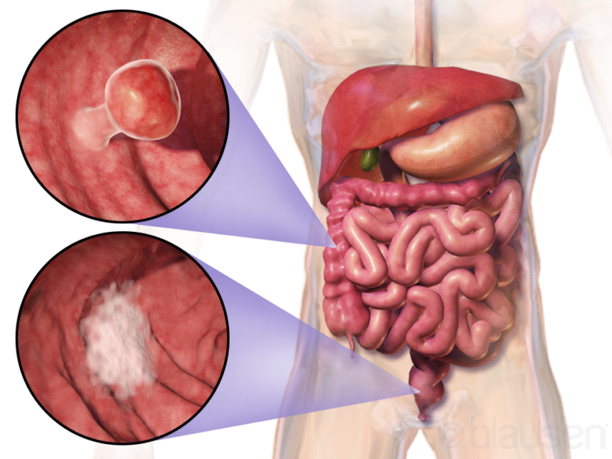 The Importance of Early Detection in Colon Cancer Survival Rates