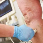 The Role of Varithena in Treating Chronic Venous Issues