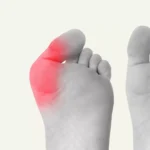 Understanding the Causes and Treatment Options for Bunions