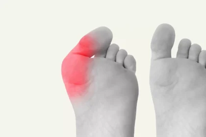Understanding the Causes and Treatment Options for Bunions