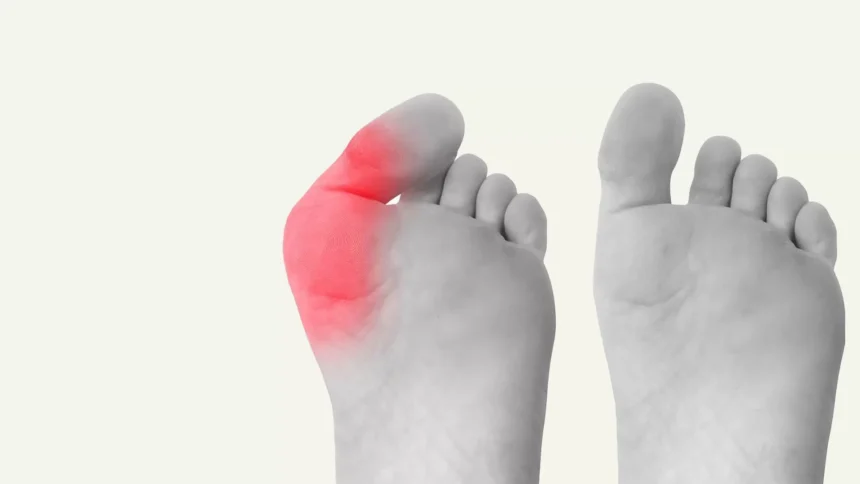 Understanding the Causes and Treatment Options for Bunions