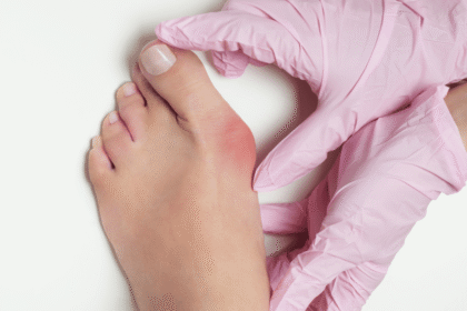 What Causes Bunions and How Do I Treat Them?