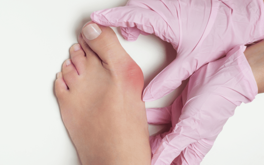 What Causes Bunions and How Do I Treat Them?