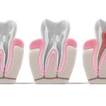 What Is a Root Canal and When Is It Needed?