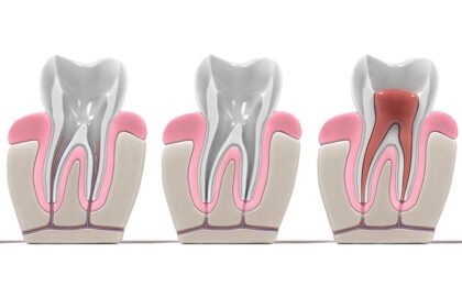 What Is a Root Canal and When Is It Needed?