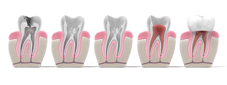 What Is a Root Canal and When Is It Needed?
