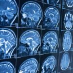What To Expect Before and After Brain Surgery