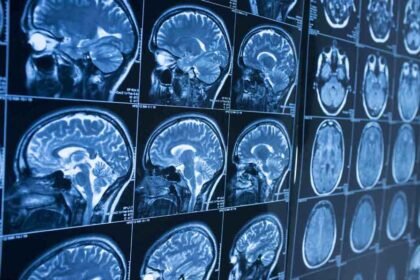 What To Expect Before and After Brain Surgery