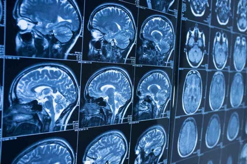 What To Expect Before and After Brain Surgery