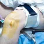 What To Expect From a Walk-in Orthopedic Consultation