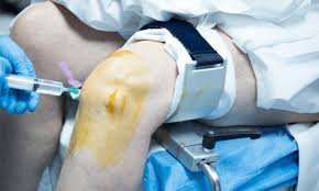 What To Expect From a Walk-in Orthopedic Consultation