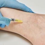 What to Expect from Sclerotherapy for Vein Treatment