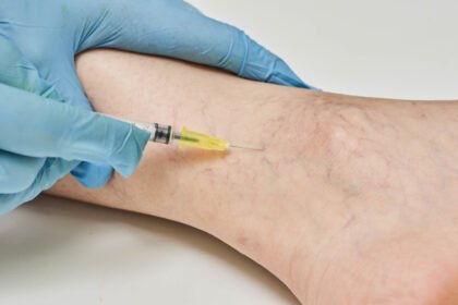 What to Expect from Sclerotherapy for Vein Treatment