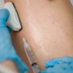 When Should You See a Doctor for Spider Veins?