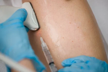 When Should You See a Doctor for Spider Veins?