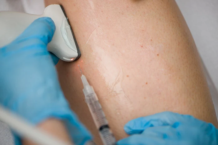 When Should You See a Doctor for Spider Veins?