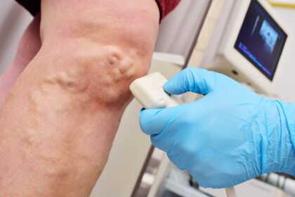 Who Do I See for Varicose Vein Treatment?