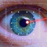 Aftercare Tips Following LASIK Surgery