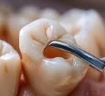 Alternatives to Dental Extractions for Severe Tooth Problems