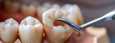 Alternatives to Dental Extractions for Severe Tooth Problems