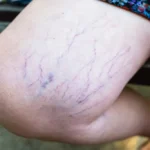 Lifestyle Changes To Prevent Varicose Veins From Worsening