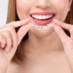 The Advantages of Invisalign Over Conventional Braces