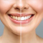 Tips for Maintaining Your Teeth Whitening Results