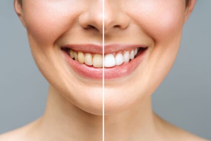 Tips for Maintaining Your Teeth Whitening Results