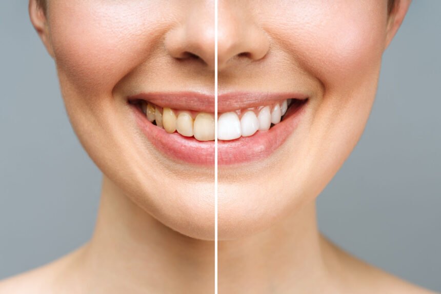 Tips for Maintaining Your Teeth Whitening Results